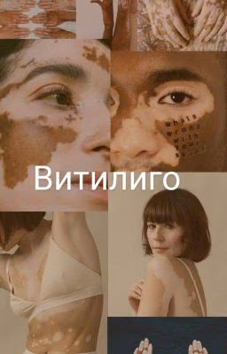 Витилиго.